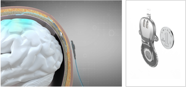 癱瘓患者已能下床！上海完成首例腦機(jī)接口產(chǎn)品臨床試驗(yàn)植入手術(shù)