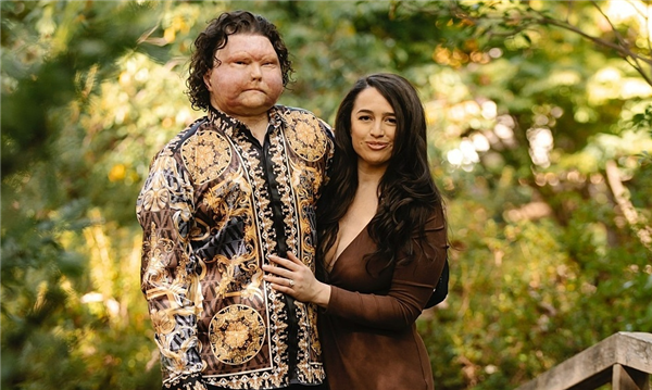 因車禍全身被重度燒傷：全球首例成功換臉換手男子將結(jié)婚